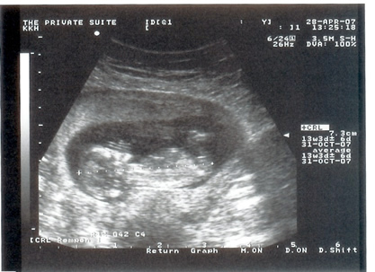 13 week old unborn baby