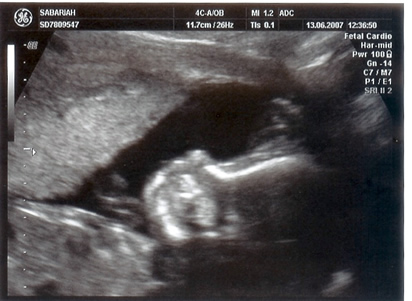 19.9 Week old unborn baby